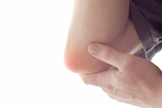 Elbow bursitis. Man with painful and infection elbow. Healthcare and medical concept. 