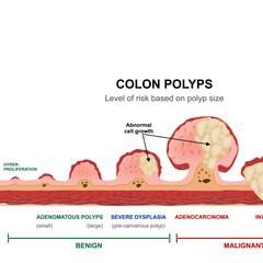 Colon Polyps Cancer Stages Illustration