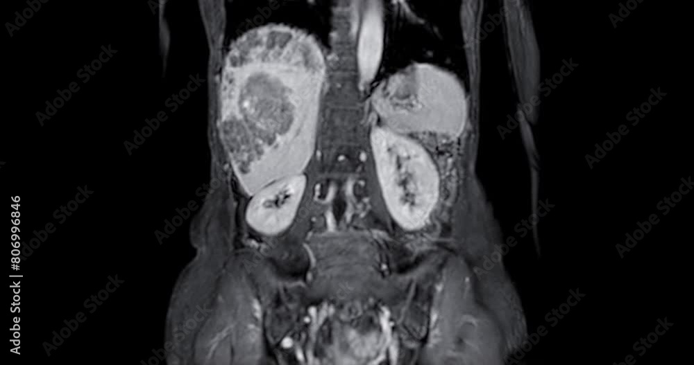 Poster ct abdomen show a retroperitoneal mass with a peripheral fatty component with thin septa and poorly 