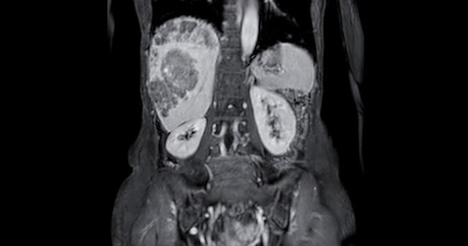 CT Abdomen show a retroperitoneal mass with a peripheral fatty component with thin septa and poorly defined solid-appearing areas with no clear demarcation between them and fat.