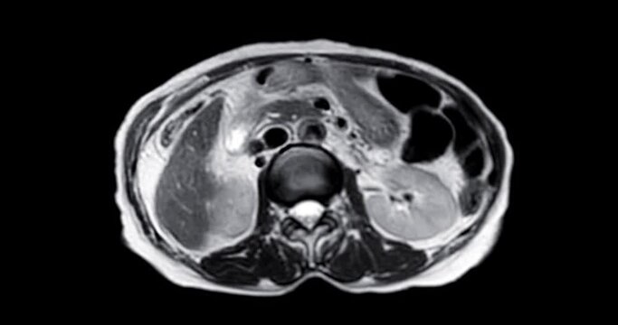 Abdominal MRI identifies liver masses, guiding further evaluation and management decisions for optimal patient care.