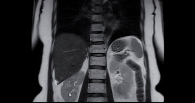 Upper abdominal MRI displays normal anatomy and organ structures, serving as a reference for future evaluations and medical examinations.