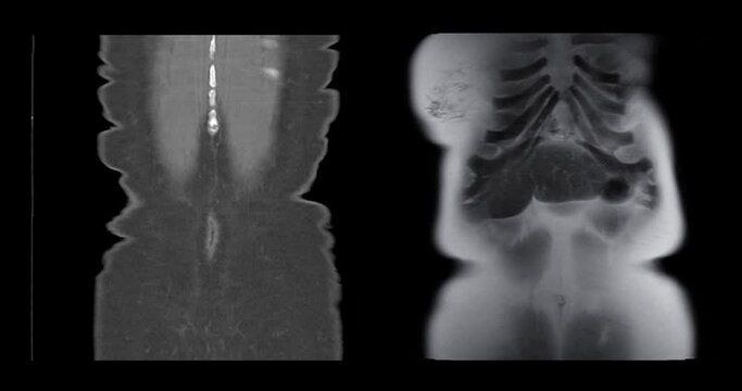 MRI Whole abdomen showing Cystic retroperitoneal dedifferentialed liposarcoma.