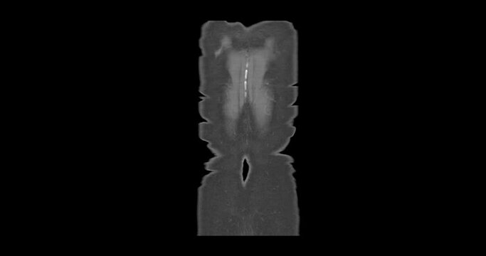 MRI Whole abdomen showing Cystic retroperitoneal dedifferentialed liposarcoma.