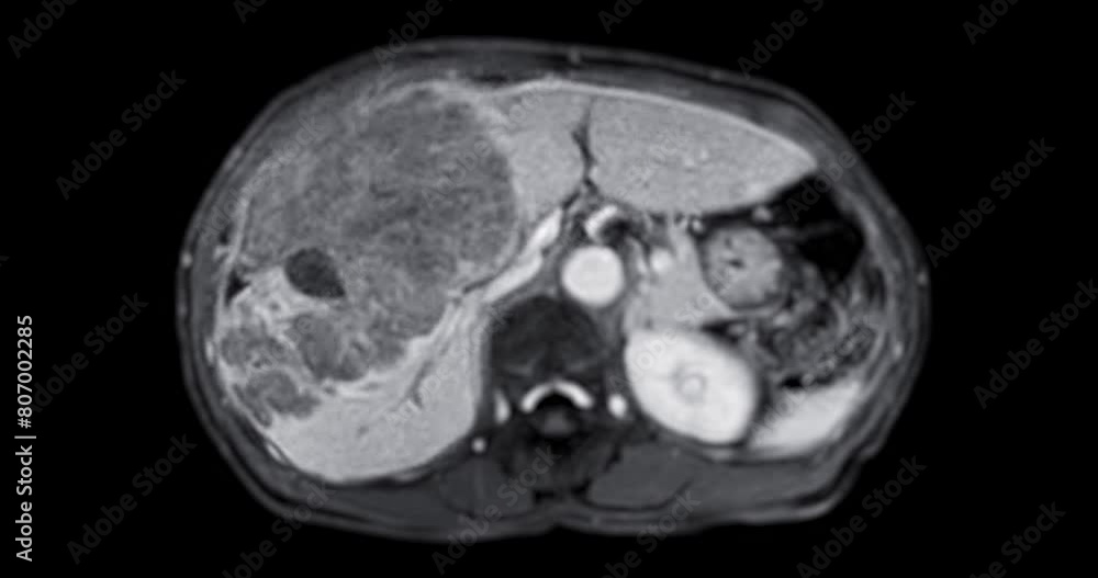Poster ct abdomen show a retroperitoneal mass with a peripheral fatty component with thin septa and poorly 