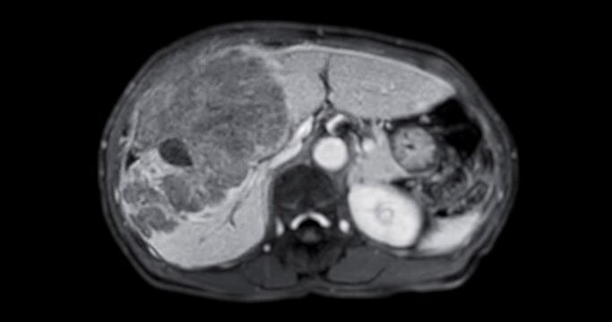 CT Abdomen show a retroperitoneal mass with a peripheral fatty component with thin septa and poorly defined solid-appearing areas with no clear demarcation between them and fat.