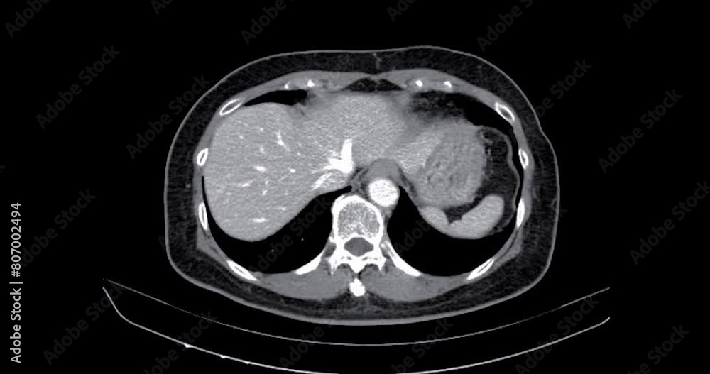 Poster ct abdomen show a retroperitoneal mass with a peripheral fatty component with thin septa and poorly 