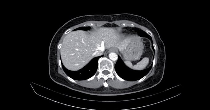 CT Abdomen show a retroperitoneal mass with a peripheral fatty component with thin septa and poorly defined solid-appearing areas with no clear demarcation between them and fat.