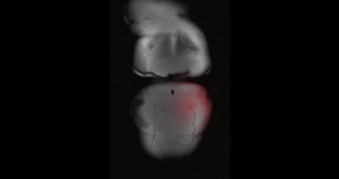 MRI Whole abdomen showing Cystic retroperitoneal dedifferentialed liposarcoma.