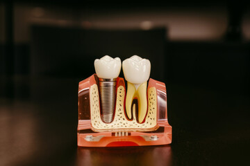 Detailed model of dental implants and tooth anatomy on desk
