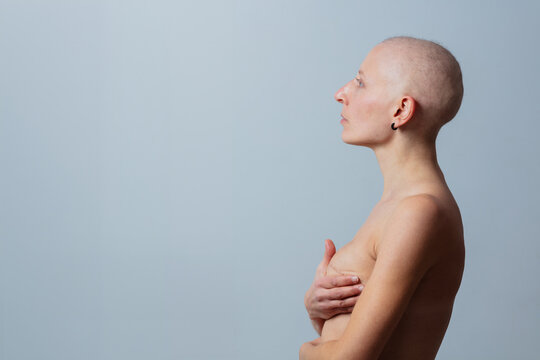 Woman with shaved head hold breast after mastectomy operation