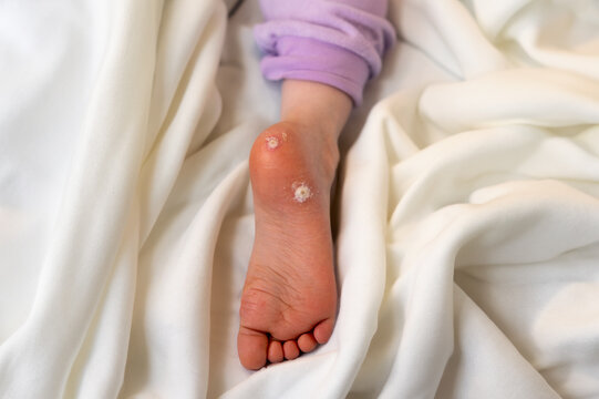 Two warts on the sole of a six year old girl. - Powered by Adobe