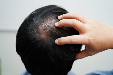Bald head in man, hair loss treatment health problem.