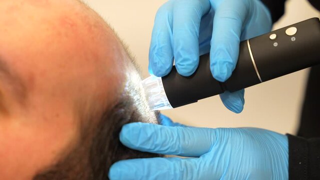 Close-up of the upper part of the head of a man at the spa getting an baldness treatment with laser