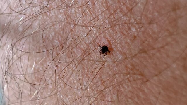 tick sucking blood on human skin close-up