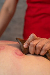 Close-up of a masseur doing a restorative massage of a man's back after vacuum cupping therapy...