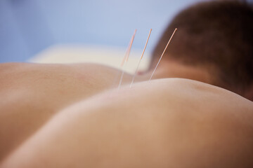 Acupuncture, needles and healing treatment of body in healthcare wirth back pain, injury or relief in muscle. Clinic, patient and physiotherapy dry needling to relax and holistic care for medicine