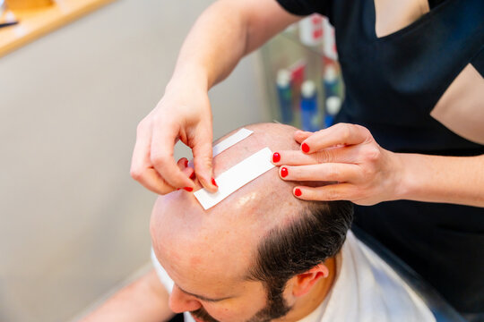 Adhesive strips on man's head to attach a capillary prosthesis