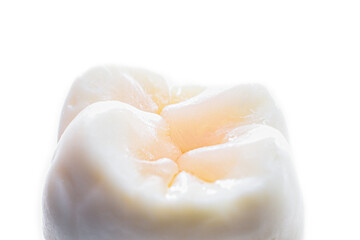tooth restorations with esthetic composite fillings