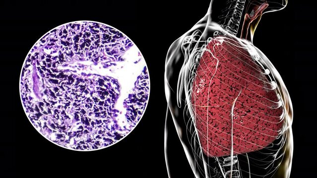 Smoker's lungs, animation