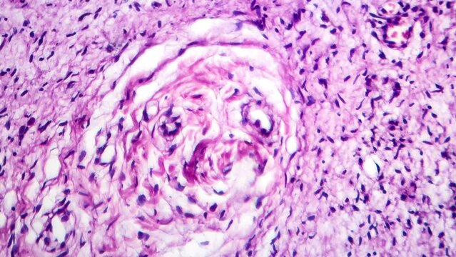 Neurofibromatosis, light microscopy