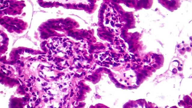 Lung adenocarcinoma, light microscopy