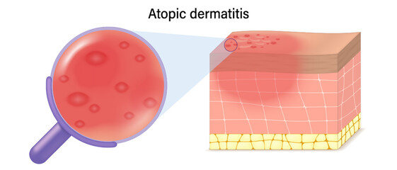 Atopic dermatitis symptoms vector. Close-up of skin cells with eczema. 