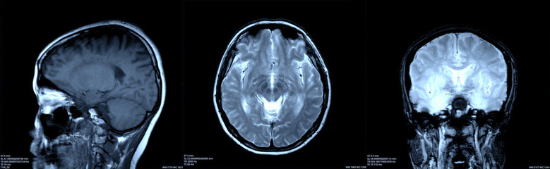 Brain x-ray images scan by mri or ct scan. radiology or radiograph concept.