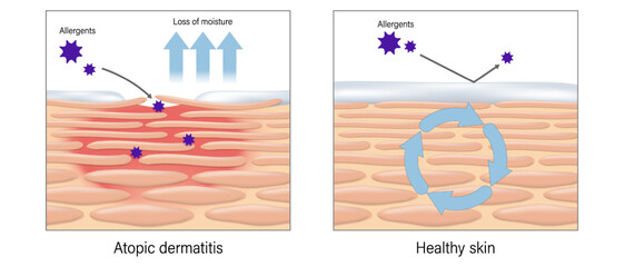 Eczema. Atopic dermatitis vector. Comparison between topic dermatitis and healthy skin. Penetration of allergens causes skin allergies.