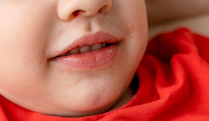 Close-up of a boy's face with red spots near the mouth, atopic dermatitis, allergies, rash and...