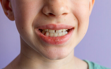 Mouth of a 9 years old boy. The child shows baby teeth. Pediatric dentistry and periodontology, bite correction. Health and dental care, caries treatment, baby teeth