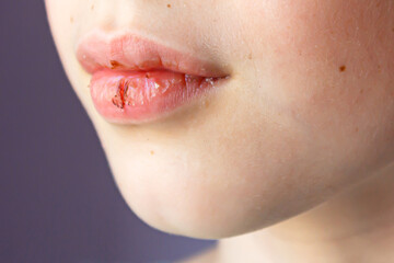Close-up of a child with dry lips and a bloody lip crack. Lip care. Soft focus