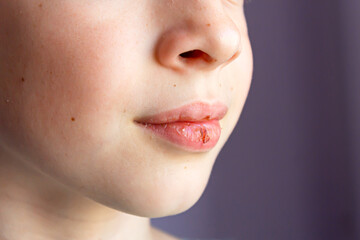 Mouth of a 9 years old boy. Close-up of a child with dry lips and a bloody lip crack. Lip care