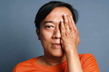 Young Man Covering One Eyes with Keloid Hands Over Gray Background. 