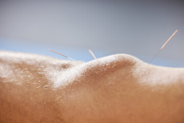 Acupuncture, knee and treatment of body in healthcare, healing muscle and relief from pain....