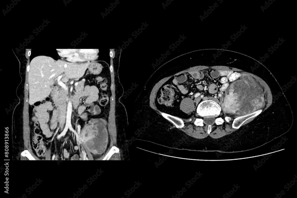 Poster ct images show a left retroperitoneal mass with a peripheral fatty component with thin septa and poo
