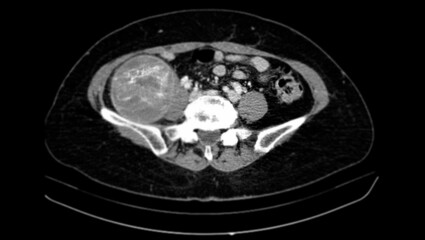 CT images show a right retroperitoneal mass