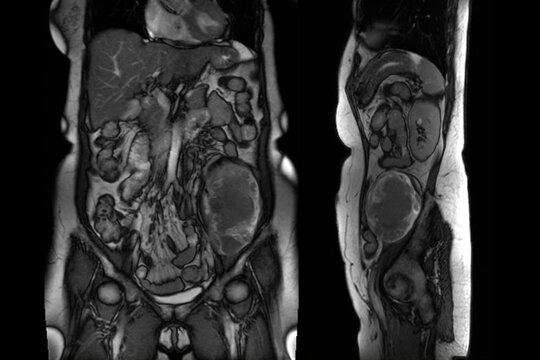 An 63-year-old female with Cystic retroperitoneal dedifferentialed liposarcoma