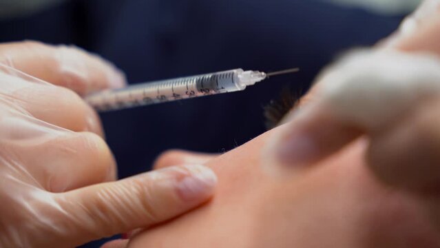 Cosmetologist doctor making multiple injections biorevitalization in woman face skin cheekbone, closeup shot. Mesotherapy, beauty concept