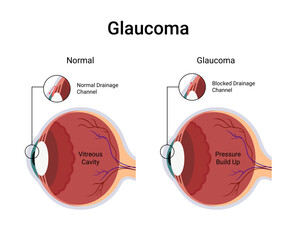 Diagram of glaucoma affected human eye and normal eye