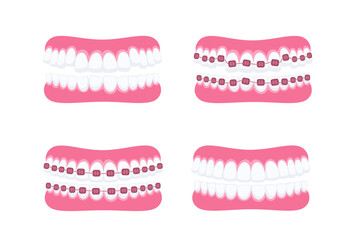 Teeth with braces. Orthodontic treatment. Tooth braces. Teeth with metal brackets