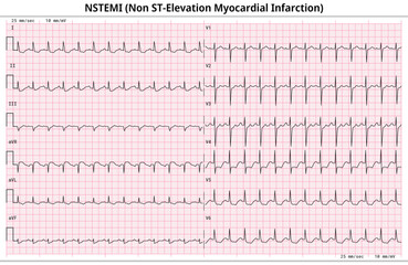 Non ST-Elevation Myocardial Infarction (NSTEMI) - ECG Paper 12 Lead - 6 Sec/lead - Medical Vector Illustration 