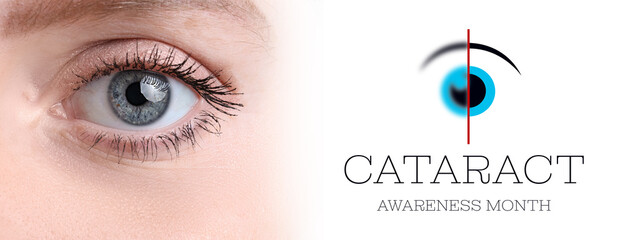 Eye of young woman, closeup. Banner for Cataract Awareness Month