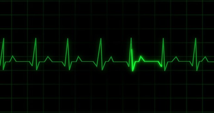 
EKG Heartbeat reading animation on black background in 4K. Medical monitor displaying cardiography pulse checkup diagnosis electronic screen display machine. Cardiogram nubes rate ecg waveform surger