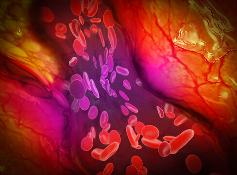 Venous thrombosis caused by the use of the vaccine. Microscopic view of a thrombosis. 3D rendering