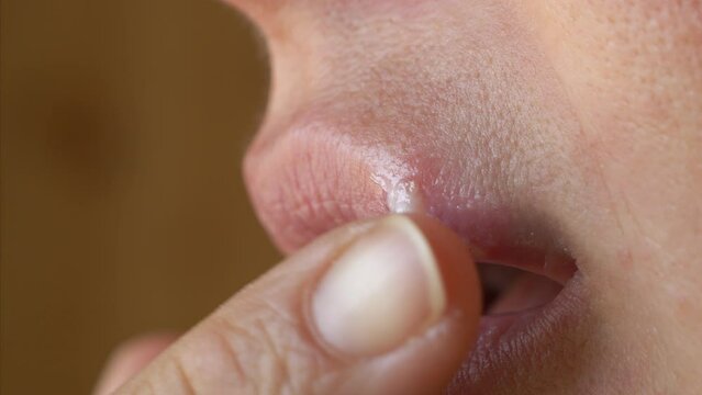 CLOSE UP: Young woman with herpes gently applying medical ointment on top lip