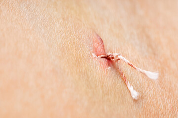 Medical suture with threads on the human body close-up
