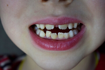 Closeup of a child's face with open mouth, teeth, gap, swinging tooth 