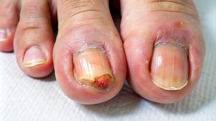 The condition of the toenail is inflamed.