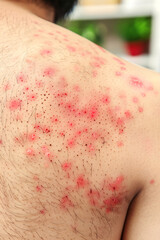 Fototapeta premium Detailed view of a red, inflamed skin rash on a person's back, discomfort and irritation.